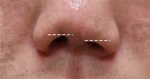韩国崔宇植整形唇腭裂修复手术经历回顾-从唇腭裂恢复到正常人状态