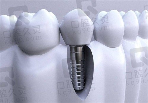 西宁德宇口腔种植牙怎么样？韩国登腾植体4500起广泛适用