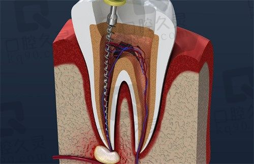 深圳瑞尔齿科价目表显示:前牙根管治疗一颗牙880元起非常划算
