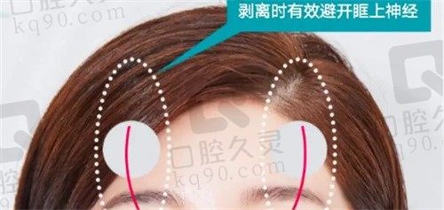 韩国优雅人朴哲佑额头缩小手术,内窥镜剥离手法轻柔1.5w-3w不等