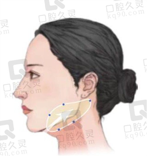 韩国清潭first整形小切口拉皮,成镇模分部位提升切口小维持久