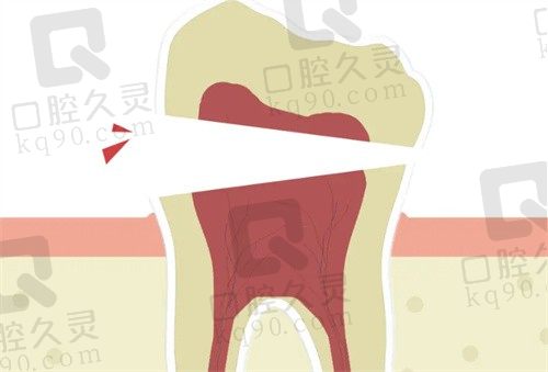 牙折裂和牙折断区别?牙裂了是修复还是拔掉?点击查看补救措施