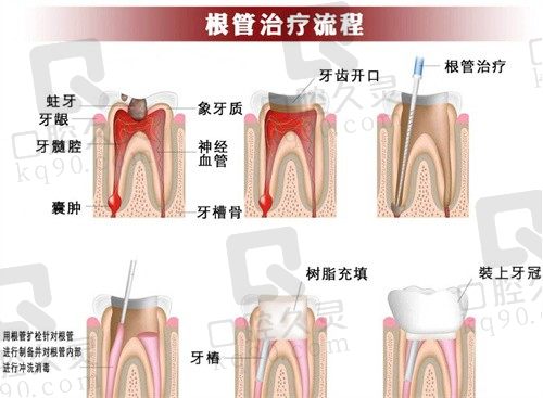 根管治疗后的牙齿又疼了怎么办?做二次根管治疗好还是拔了好?