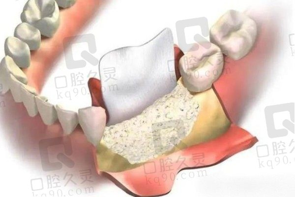 种植牙中的植骨是什么意思？究竟植骨好还是不植骨好呢？