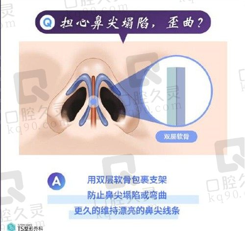 韩国短鼻/挛缩鼻整形首选TS,鼻中隔延长+双层软骨包裹防弯曲下垂