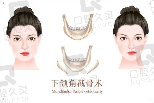 北京张笑天下颌骨手术怎么样?下颌角长曲线截骨4.8w起风险小
