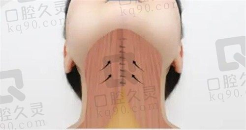 韩国Pride普爱德下巴肌肉捆绑,面部提升+脂肪填充后下颌缘超清晰
