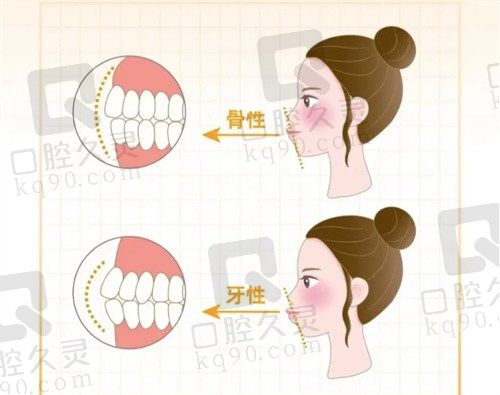 骨性凸嘴只能做手术了吗?不手术怎么改善骨性嘴凸?