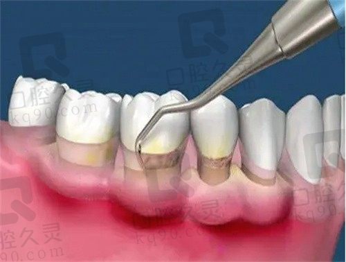 龈下刮治后牙龈会重新包紧牙吗?龈下刮治后更容易结石吗？
