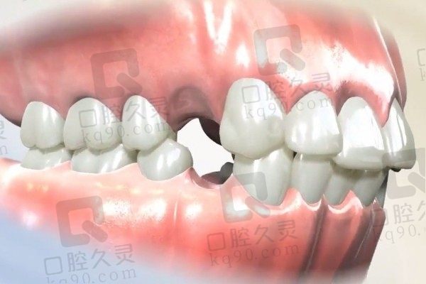 拔掉4颗牙齿矫正是否值得？正畸拔牙会导致牙齿松动吗？