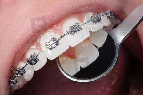 箍牙可以只箍上面一排吗？可以，但牙医一般不建议半口正畸