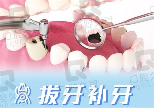 纳米补牙和树脂补牙哪个好?树脂补牙能维持多久?
