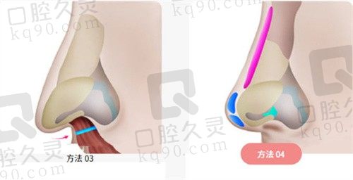 韩国原辰鼻基底手术改善法令纹,康文硕等院长主刀切口隐蔽20000起