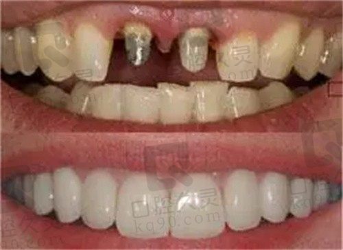 上海鼎植口腔种植牙后当心5个并发症,做好这些准备很重要