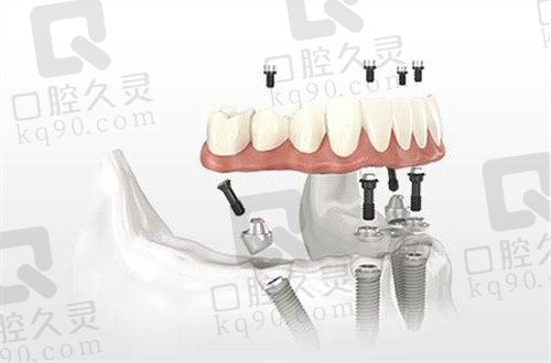 种植牙为什么要等三个月才安装牙冠?安装牙冠后注意事项一览