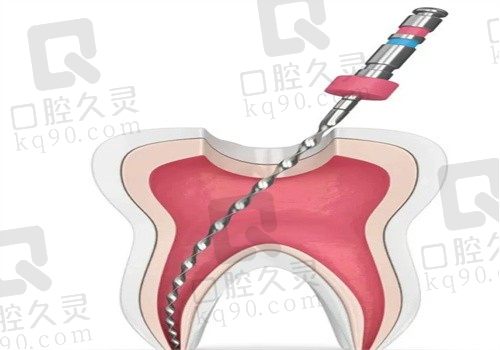 根管治疗一般能管几年?十年,还想知道步骤流程痛不痛以及注意事项