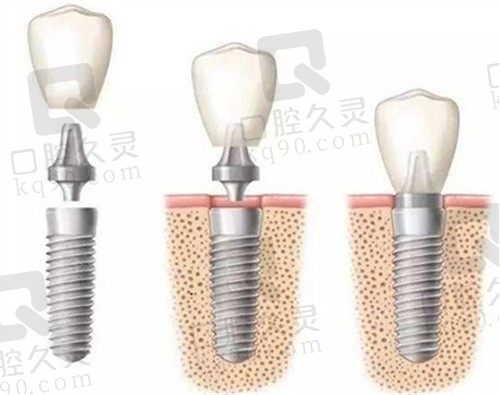 青岛中诺口腔医院怎么样？种牙韩国登腾2980元起