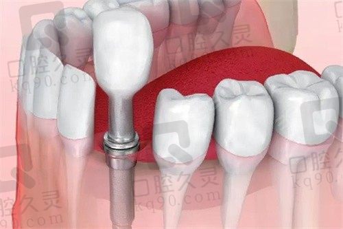 重庆泰康拜博口腔医院种植牙多少钱？2980元起超便宜！附地址