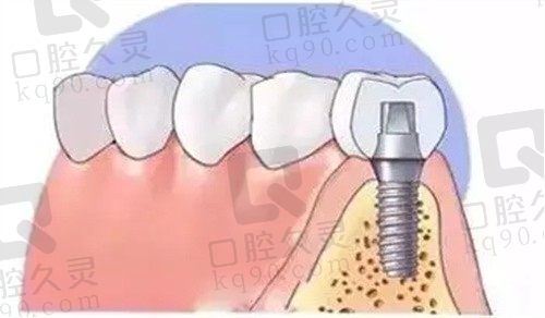 娄底爱牙邦口腔医院赵德强做韩国登腾种植牙仅需3980元起，种植技术好