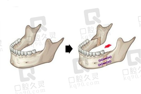 正颌手术算整容吗？算，能改变大小脸/下巴后缩等脸型问题