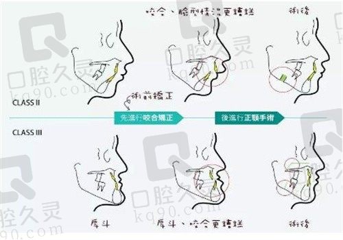 周会喜正颌手术做的怎么样?周会喜个人资料看正颌技术好案例多价格5万+