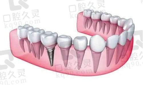 枣庄澳美口腔邵泽成美国皓圣种植牙约5000元起，种牙技术真的好