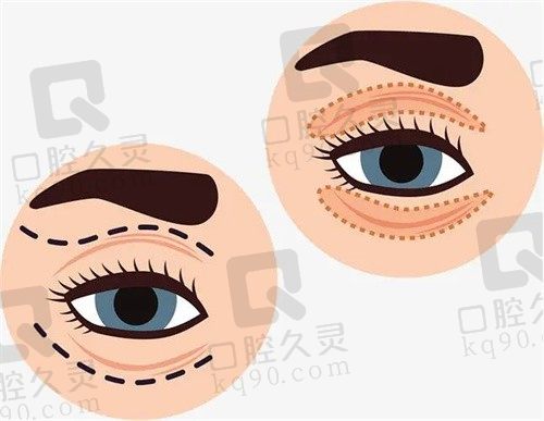北京张冰洁修复双眼皮怎么样？4-ARC综合眼修复3.6万起价格不贵技术超好！