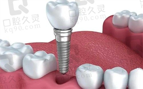 成都新桥口腔医院叶宏做意大利CLC种植牙3680起，技术成效好