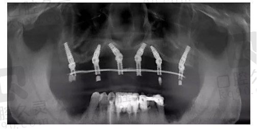 在上海曙康口腔做半口六颗种植牙经历分享，恢复半口牙齿仅3万元起真实惠!