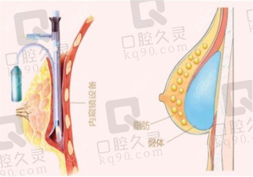 广州隆胸医生排名前十一览表:丰胸医师李俊明/蒋思军/黄广香等均上榜