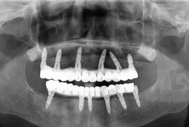 花8万在桂林柏乐口腔做全口种植牙全过程,种植牙价格贵但是效果真的比镶牙好!