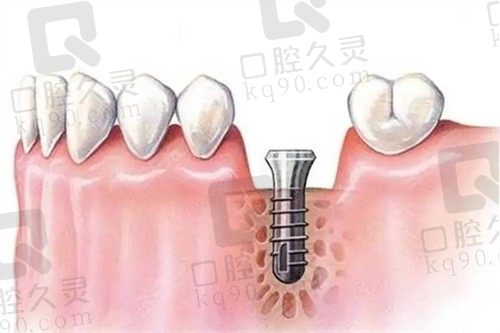 大连雅馨口腔医院种植牙怎么样？王明伟医生种牙技术好，高难度种植/穿颧穿翼都能做