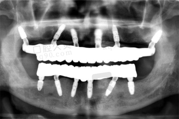 青岛中诺口腔医院种植牙价格低体验好！爷爷种了全口牙成效惊喜