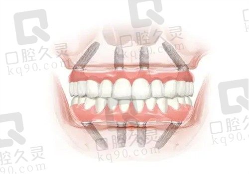 重庆城口众合口腔种植牙亲身体验分享！孙玺医生技术真的没话说