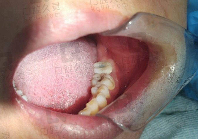 在西安中诺口腔医院做后牙即刻种植牙，分享即拔即种案例和种牙价格！