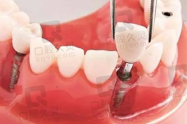 兰州台牙口腔医院杜强院长瑞士ITI种植牙 6980元起，价格划算缺失多颗牙都适用
