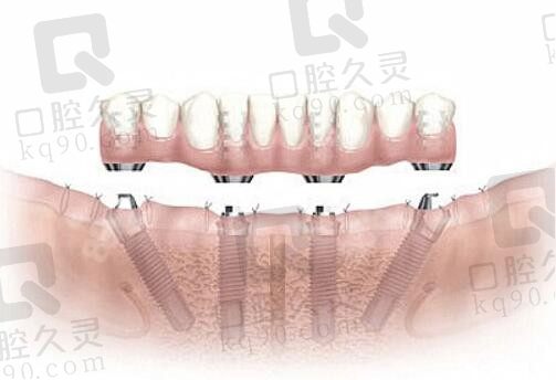 长沙美奥口腔医院全口种植牙价格4万元，外观自然且轻松解决吃饭难题