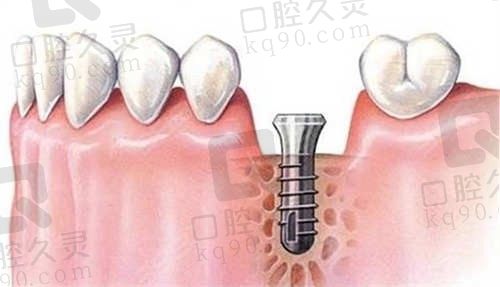 武汉咿呀口腔向辉医生韩系进口种植牙套餐2362元起，一口价种植很实惠！