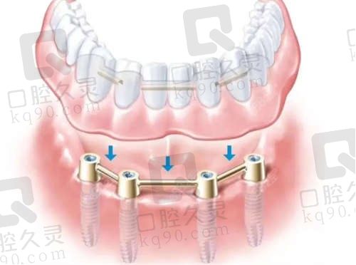 我在昆明崇臣口腔做了半口all-on-4种植，朱立楠医生技术非常不错，即种即走
