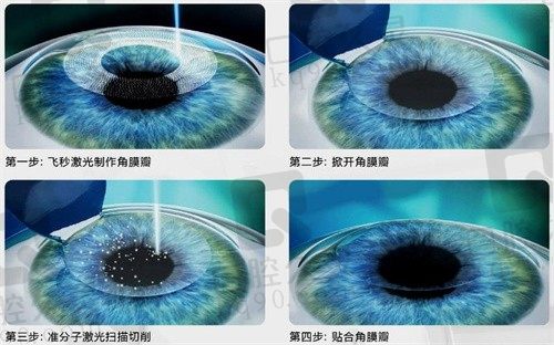 绵阳富临医院眼科全飞秒激光SMILE 3.0手术价格8800元起，开启清晰视界