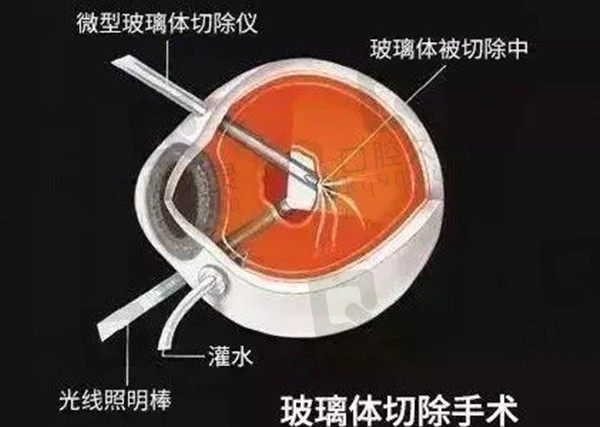 玻璃体切割手术需要多少钱？分享手术过程及手术后需要注意什么