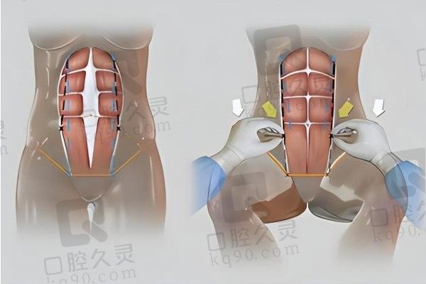 深圳八大处腹壁整形价格4W起！贾振华医生可在线预约挂号