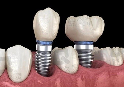 推荐上海丽泽口腔医院种植牙，1万就能做两颗瑞士ITI种植牙超划算