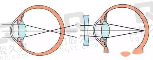 淮北爱尔眼科医院准分子激光近视手术6000元起，个性化定制清晰视界