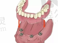 上半口种植牙六颗好还是八颗好？半口种植牙要打几个钉？