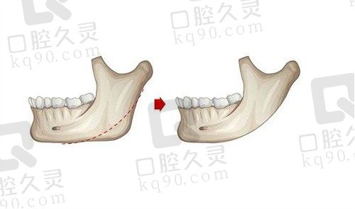 重庆安可忍磨骨好不好?从案例看安可忍3D面部重建轮廓技术超好效果自然