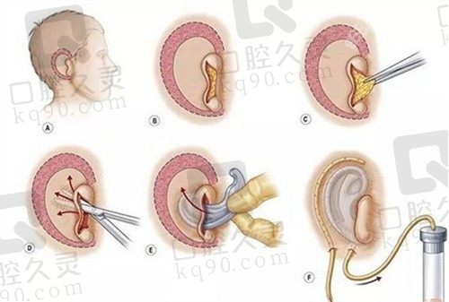 广州新市万伟东医生单侧全耳再造6W元起，自体肋软骨雕刻技术排异反应小仿真效果好