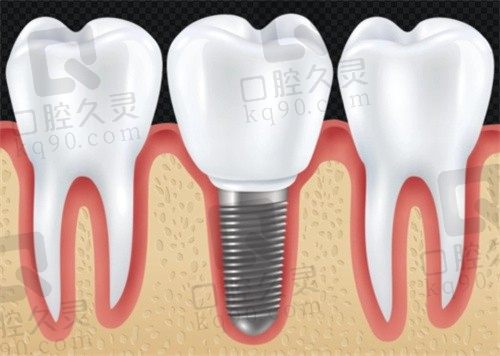 宁波佳兴口腔医院种植牙价格贵吗?奥齿泰仅需2980元起,经验丰富的种植专家亲诊!