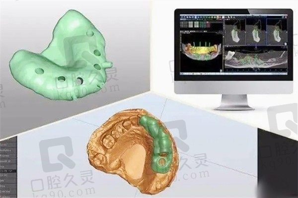 数字化种植牙有什么优点？过程步骤科技化并且种牙微创不疼噢