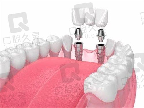 深圳爱康健口腔医院卢勇辉皓圣种植牙4980元起，进口品质有保障